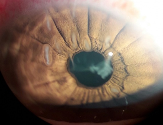 Filaments over cornea in a patient with severe DES