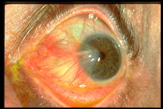 A large pterygium that has extended onto the cornea