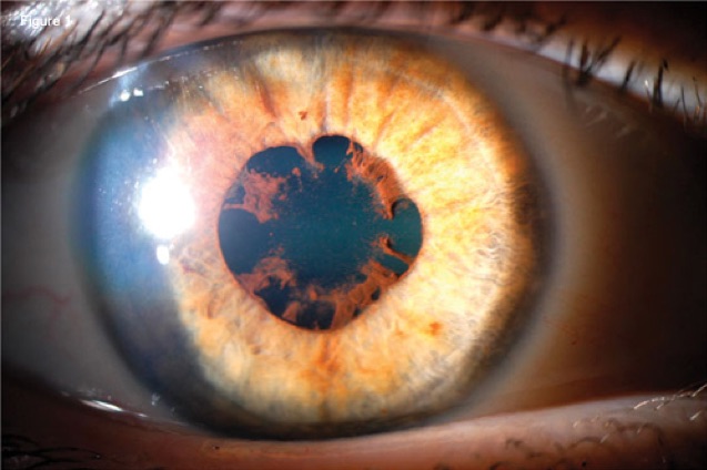 Synechia or iris detachment caused by inflammation