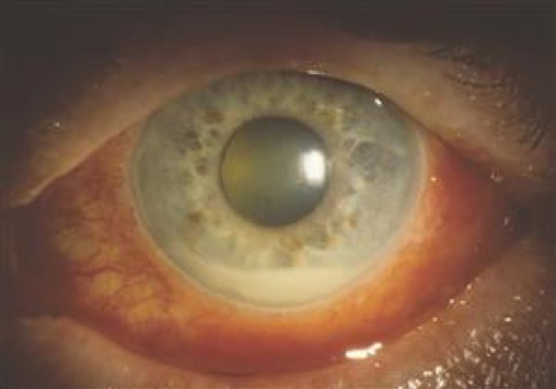 A hypopyon or a cluster of white blood cells in the anterior chamber, can be a sign of uveitis