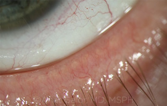 Dilated blood vessels of the lid margin in a patient with rosacea